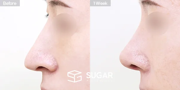 슈가성형외과 재) 재수술 + 무보형물 + 긴코 + 휜코 + 매부리 + 절골 + 기증늑 + 귀연골 + 귀 뒤 근막 + 비중격만곡… 전후사진 - 측면 수술 전후 비교