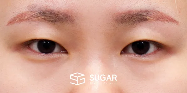 슈가성형외과 첫) 자연유착 전후사진 - 수술 전