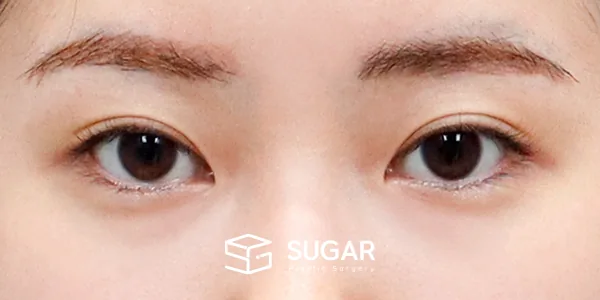 슈가성형외과 재) 재수술 + 뒤밑트임 전후사진 - 수술 전