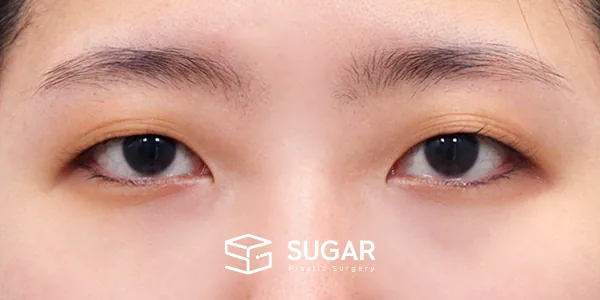 슈가성형외과 첫) 자연유착 + 눈매교정 전후사진 - 수술 전