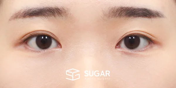 슈가성형외과 첫) 눈 밑 지방재배치 + 뒤밑트임 전후사진 - 수술 후