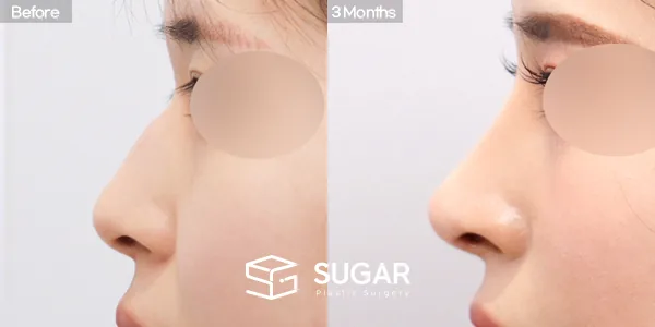 슈가성형외과 첫) 콧대 + 코끝 + 휜코 + 매부리코 + 절골 + 비주 근육 절제 + 귀연골 전후사진 - 측면 수술 전후 비교