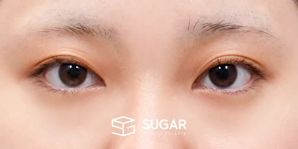 슈가성형외과 첫) 자연유착 + 눈매교정 + 뒤밑트임 전후사진 - 수술 전