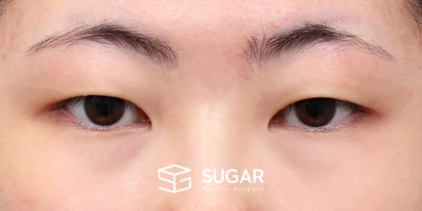 슈가성형외과 첫) 절개 + 눈 밑 지방재배치 + 윗트임 + 뒤밑트임 전후사진 - 수술 전