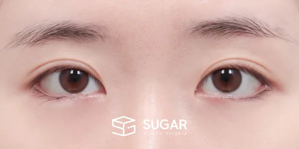 슈가성형외과 첫) 자연유착 + 눈매교정 + 뒤밑트임 전후사진 - 수술 후
