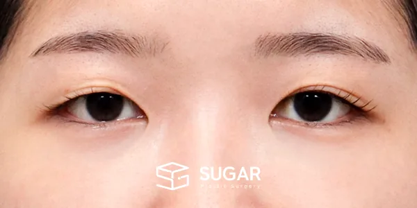 슈가성형외과 첫) 자연유착 + 눈매교정 + 앞트임 + 윗트임 전후사진 - 수술 전