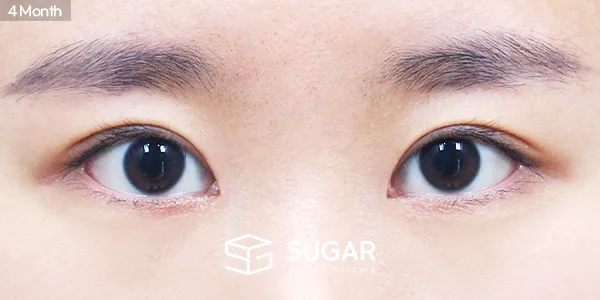 슈가성형외과 첫) 자연유착 + 눈매교정 + 앞트임 전후사진 - 수술 후