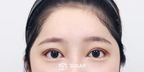 슈가성형외과 재) 뒤밑트임 재수술 + 이마거상 전후사진 - 수술 후