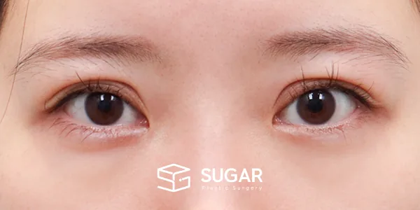 슈가성형외과 재) 재수술 + 절개 + 윗트임 + 뒤밑트임 전후사진 - 수술 전
