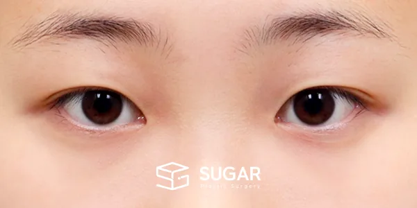 슈가성형외과 첫) 자연유착 + 눈매교정 + 윗트임 전후사진 - 수술 전