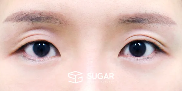 슈가성형외과 재) 절개 재수술 + 눈 두덩이 지방재배치 + 윗트임 + 앞트임 + 뒤밑트임 전후사진 - 수술 전