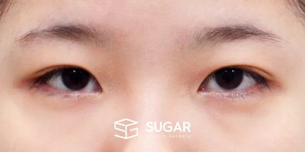 슈가성형외과 첫) 자연유착 + 앞트임 전후사진 - 수술 전