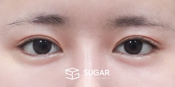슈가성형외과 재) 재수술 + 절개 + 눈매교정 + 뒤밑트임 전후사진 - 수술 후
