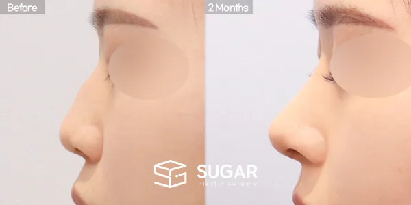 슈가성형외과 첫) 코끝 + 매부리코 + 휜코 + 절골 + 귀연골 + 귀 뒤 근막 전후사진 - 측면 수술 전후 비교