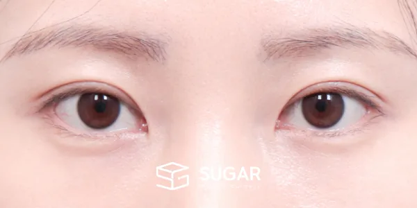 슈가성형외과 첫) 자연유착 전후사진 - 수술 후