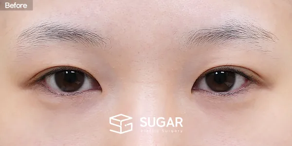 슈가성형외과 첫) 뒤밑트임 전후사진 - 수술 전
