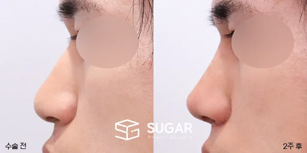 슈가성형외과 첫) 무보형물(코끝) + 매부리 + 복코 + 절골 + 비주 지지 + 비중격 연장 + 콧볼축소 + 근막 + 비중격 … 전후사진 - 측면 수술 전후 비교