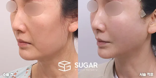 슈가성형외과 첫) 실리프팅 전후사진 - 전후 비교 사진