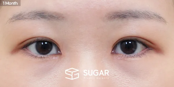 슈가성형외과 첫) 자연유착 + 눈매교정 + 앞트임 전후사진 - 수술 후