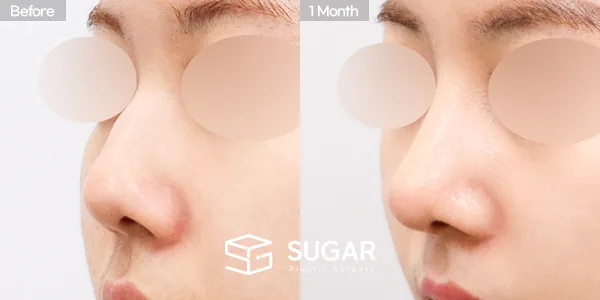 슈가성형외과 첫) 콧대 + 코끝 + 매부리코 + 절골 + 비중격 + 귀연골 전후사진 - 45도 수술 전후 비교