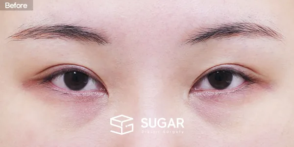 슈가성형외과 첫) 뒤밑트임 + 눈밑지방재배치 전후사진 - 수술 전