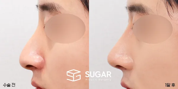 슈가성형외과 첫) 콧대코끝 + 매부리 + 휜코 + 절골 + 비중격 연장 전후사진 - 측면 수술 전후 비교