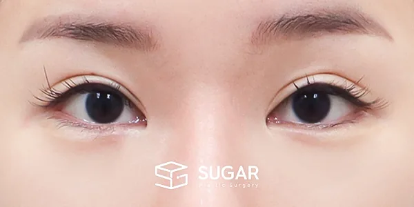 슈가성형외과 첫) 눈매교정 + 윗트임 + 2Point 웨이브 밑트임 전후사진 - 수술 전
