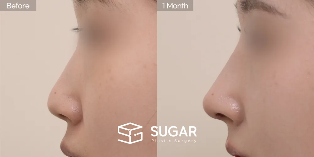 슈가성형외과 첫) 기증늑 + 귀연골 + 콧대 + 절골 + 복코 전후사진 - 측면 수술 전후 비교