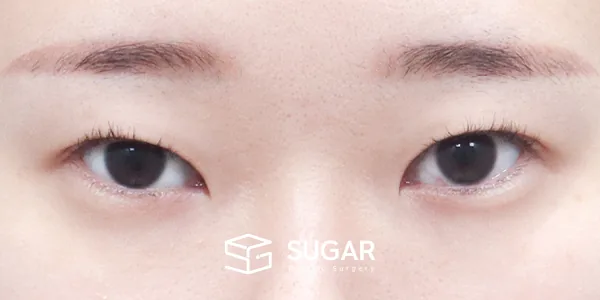 슈가성형외과 첫) 자연유착 + 눈매교정 + 윗트임 + 뒤밑트임 전후사진 - 수술 전