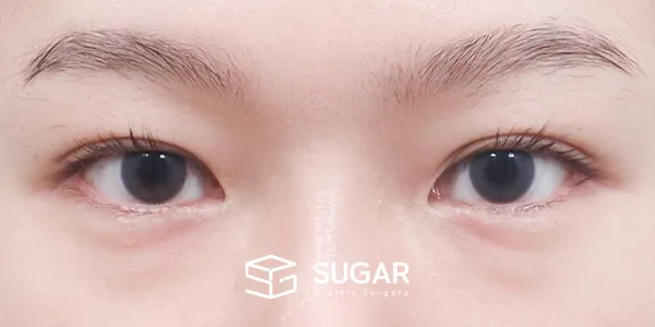 슈가성형외과 첫) 자연유착 + 눈매교정 + 윗트임 + 뒤밑트임 + 눈 밑 지방재배치 전후사진 - 수술 전