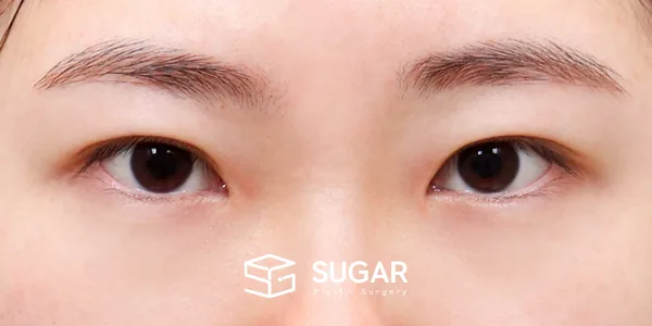 슈가성형외과 첫) 절개 + 윗트임 + 뒤밑트임 전후사진 - 수술 전