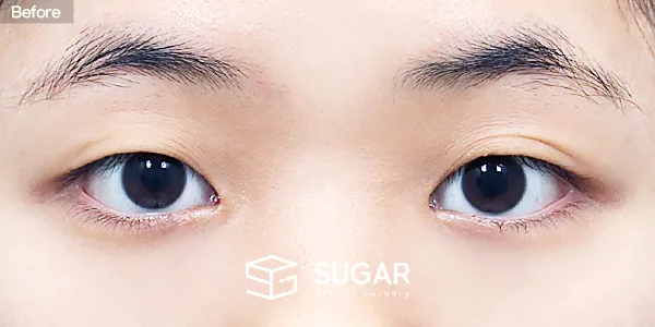 슈가성형외과 첫) 자연유착 + 눈매교정 + 앞트임 전후사진 - 수술 전