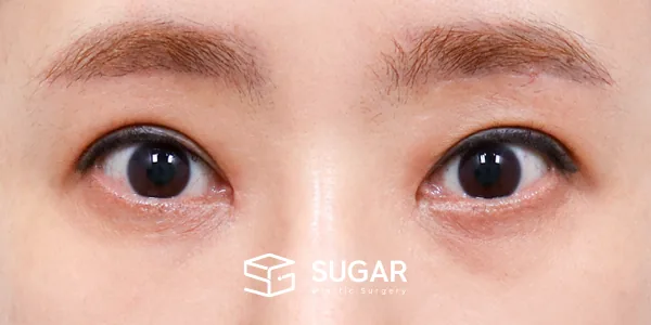 슈가성형외과 첫) 중안면부 거상 + 하안검 + 뒤밑트임 전후사진 - 수술 전