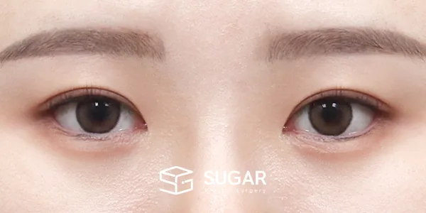 슈가성형외과 첫) 절개 + 앞트임 + 뒤밑트임 전후사진 - 수술 후