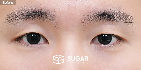슈가성형외과 첫) 자연유착 + 눈매교정 + 뒤밑트임 전후사진 - 수술 전