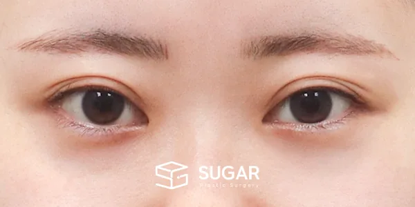 슈가성형외과 첫) 자연유착 + 눈매교정 + 뒤밑트임 전후사진 - 수술 전