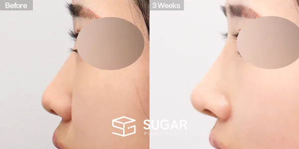 슈가성형외과 첫) 콧대 + 코끝 + 매부리코 + 복코 + 절골 + 귀연골 전후사진 - 측면 수술 전후 비교