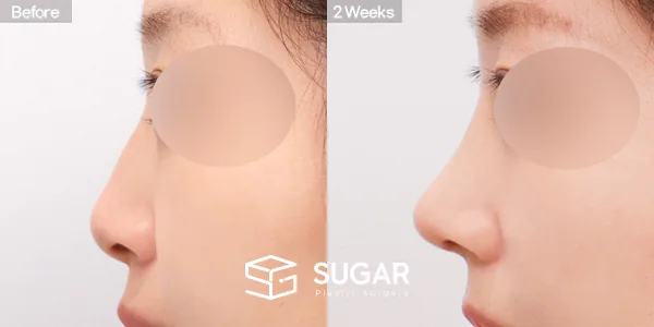 슈가성형외과 첫) 콧대 + 코끝 + 매부리코 + 무보형물 코성형 + 복코 + 절골 전후사진 - 측면 수술 전후 비교