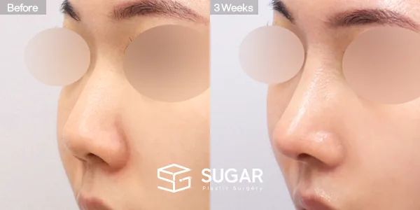 슈가성형외과 첫) 콧대 + 코끝 + 매부리코 + 짧은코 + 비중격 + 귀연골 전후사진 - 45도 수술 전후 비교