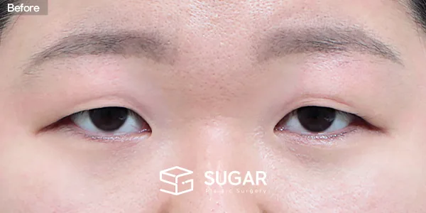 슈가성형외과 첫) 눈썹하거상술 + 눈 두덩이 지방 제거 전후사진 - 수술 전