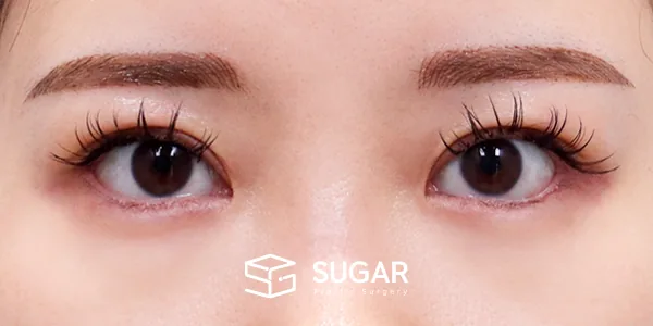 슈가성형외과 재) 재수술 + 절개 + 윗트임 + 뒤밑트임 전후사진 - 수술 후