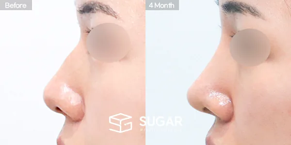 슈가성형외과 첫) 콧대 + 코끝 + 복코 + 휜코 전후사진 - 측면 수술 전후 비교