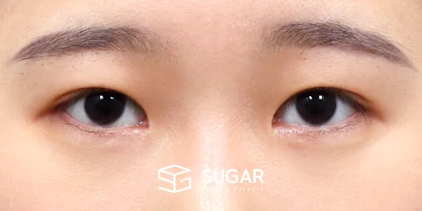 슈가성형외과 재) 재수술 + 절개(두 줄 따기) 전후사진 - 수술 후
