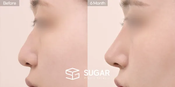 슈가성형외과 첫) 콧대 + 귀연골 + 기증늑 + 메부리 + 복코교정 전후사진 - 측면 수술 전후 비교