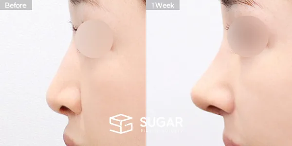 슈가성형외과 재) 재수술 + 무보형물 + 기증늑 + 매부리 + 절골 + 비순각교정 + 귀 뒤 근막 + 콧볼축소 전후사진 - 측면 수술 전후 비교