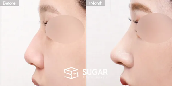 슈가성형외과 첫) 코끝 + 매부리코 + 절골 전후사진 - 측면 수술 전후 비교