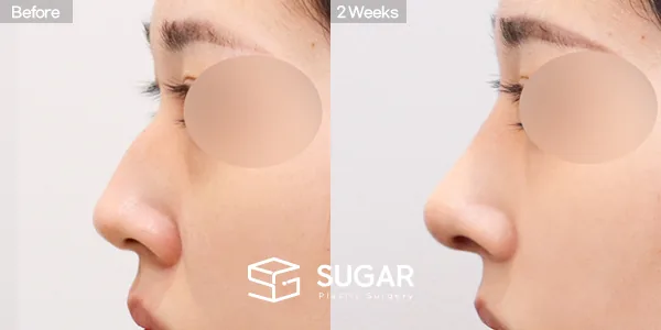 슈가성형외과 첫) 콧대 + 코끝 + 매부리코 전후사진 - 측면 수술 전후 비교