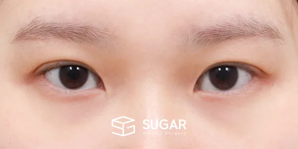 슈가성형외과 첫) 윗트임[R] + 뒤밑트임 전후사진 - 수술 전