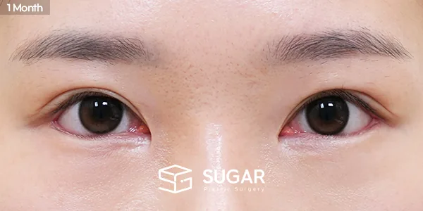 슈가성형외과 재) 재수술 + 뒤밑트임 전후사진 - 수술 후