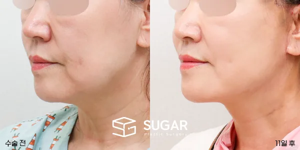 슈가성형외과 첫) 안면거상 + 심부볼 지방흡입 전후사진 - 전후 비교 사진